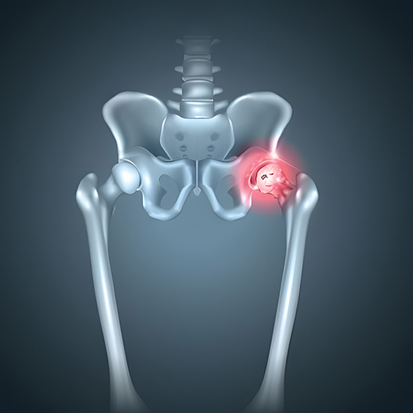 Diagnosis of AVN at YKOrthopaedics