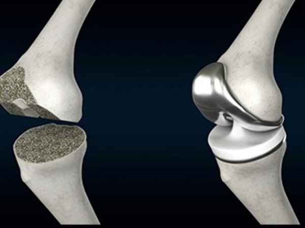 Types of Total Knee Replacement