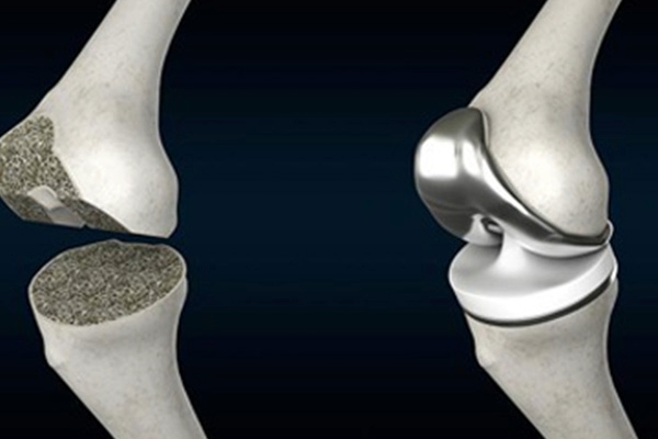 What is Total Knee Replacement Surgery in Agra?