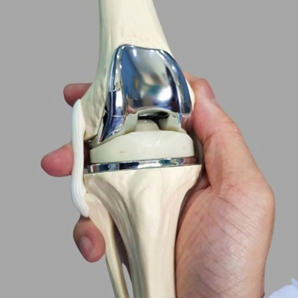 Types of Total Knee Replacement Surgery in Agra