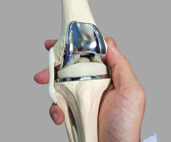 What is Total Knee Replacement?