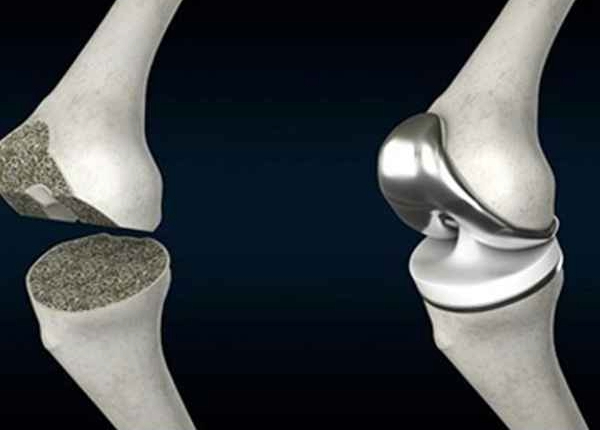 Types of Total Knee Replacement