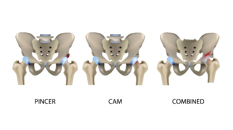 Structural Disorder of the Hip: Hip Impingement