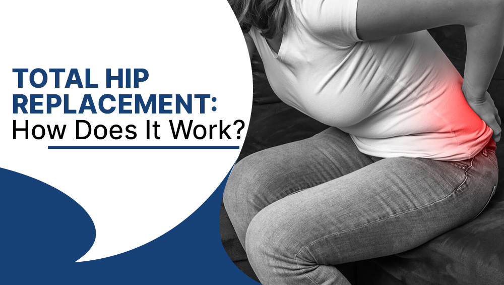 Total Hip Replacement: How Does It Work?