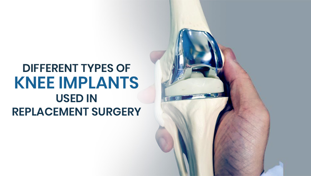 Different Types of Knee Implants Used in Replacement Surgery
